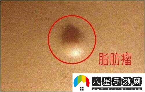 “體內豆粒疙瘩