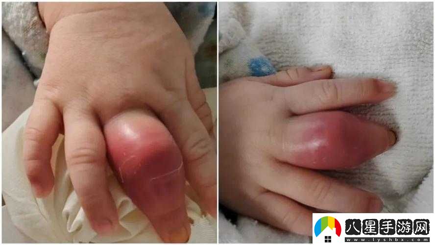 寶寶僅三根手指卻如此疼痛令人揪心