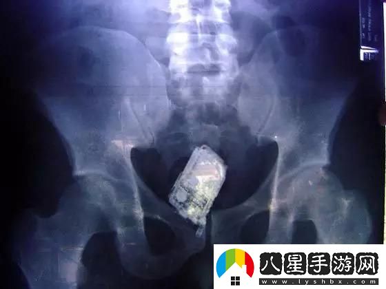 體內十年異物